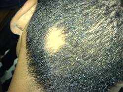 ALOPECIA AREATA