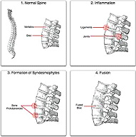 Ankylosing spondylitis 