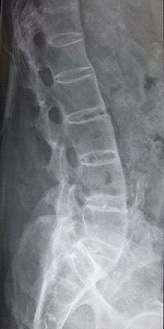 Ankylosing spondylitis 