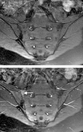 Ankylosing spondylitis 