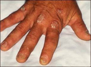 Psoriasis