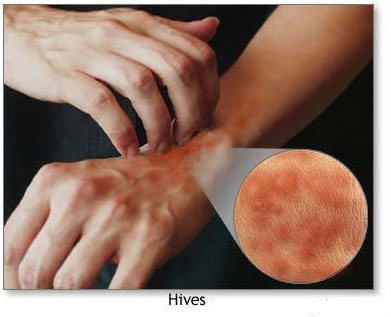 Urticaria