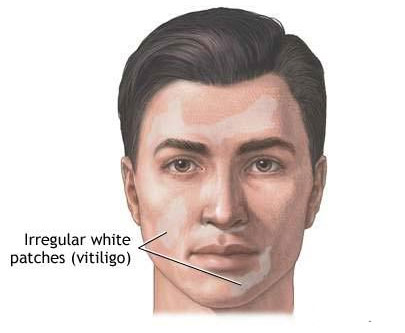 Vitiligo