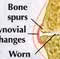 Illustration comparing rheumatoid arthritis and osteoarthritis  