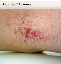 eczema