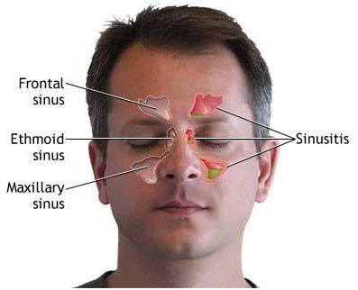 sinusitis